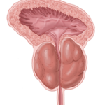 enlarged-prostate