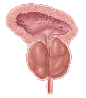 enlarged-prostate